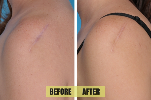 Results from using the Fat Injection procedure on a deep scar.