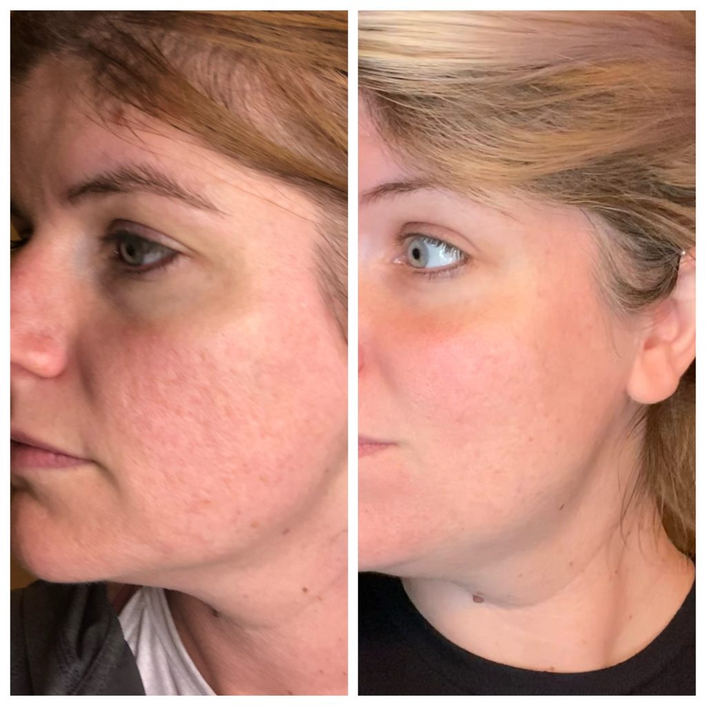 Before and after skincare after nearly a year.